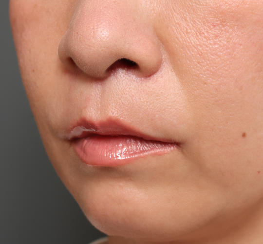 40代女性の人中短縮（リップリフト） After 症例写真
