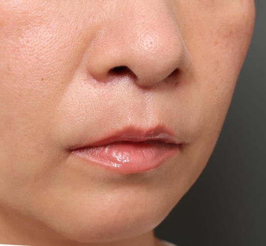 40代女性の人中短縮（リップリフト） After 症例写真