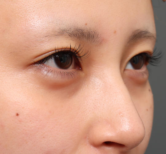 20代女性の目つき矯正 Before 症例写真