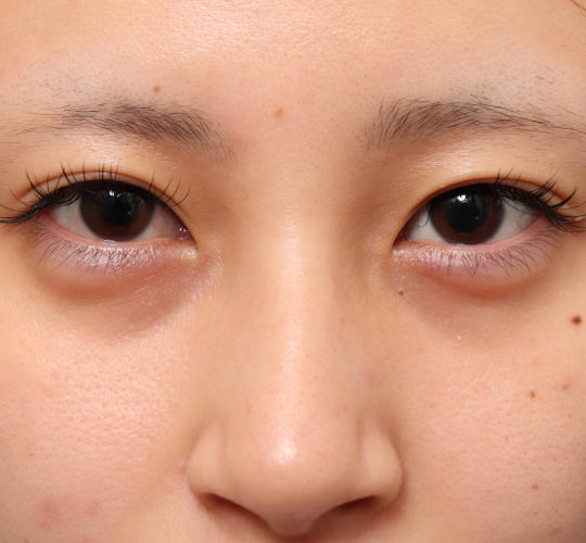 20代女性の二重整形・目元の整形 Before 症例写真