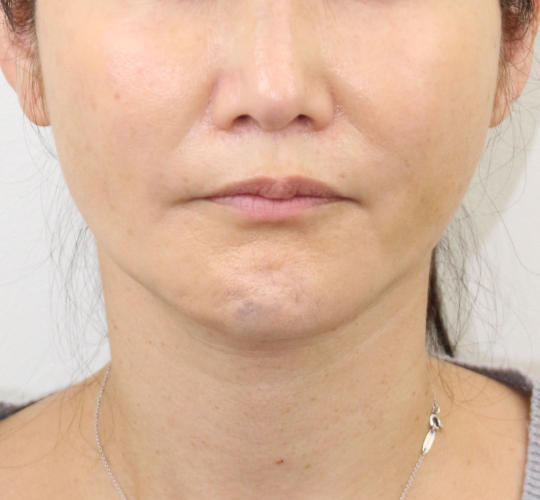 40代女性のVOVリフトプレミアム After 症例写真