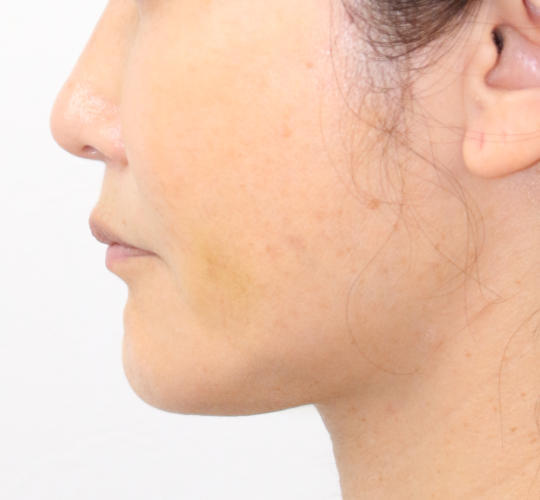 40代女性のVOVリフトプレミアム After 症例写真