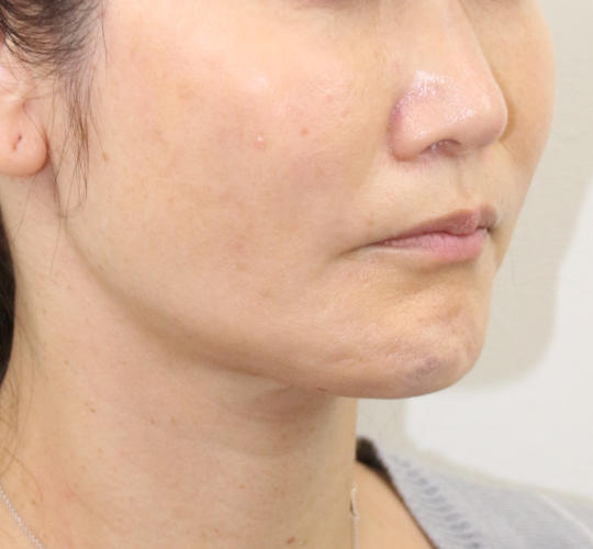 40代女性のVOVリフトプレミアム After 症例写真