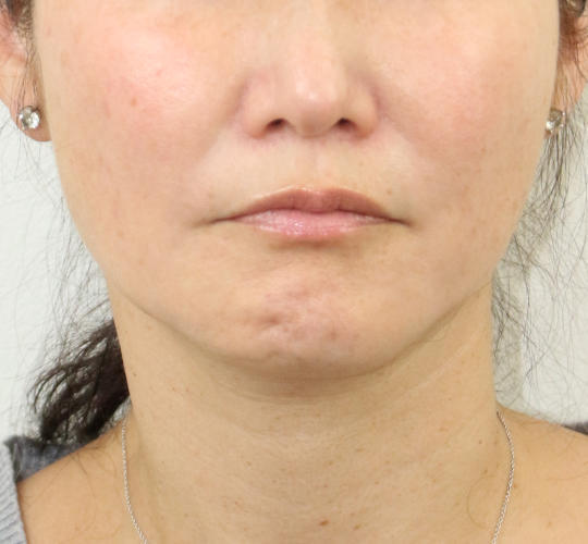 40代女性のVOVリフトプレミアム Before 症例写真