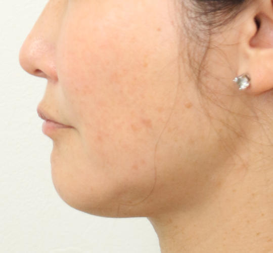 40代女性のVOVリフトプレミアム Before 症例写真