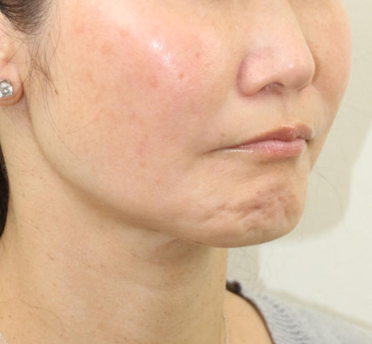 40代女性のVOVリフトプレミアム Before 症例写真