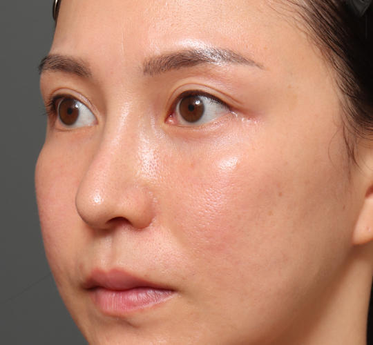 20代女性の下まぶたのたるみ取り After 症例写真