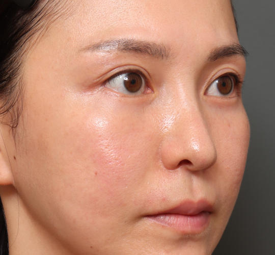 20代女性の下まぶたのたるみ取り After 症例写真