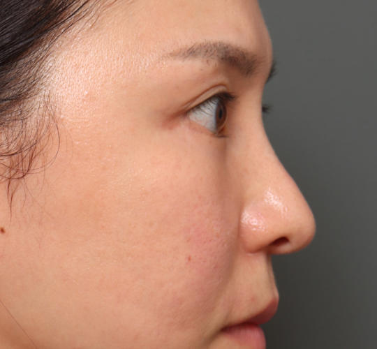 20代女性の下まぶたのたるみ取り After 症例写真