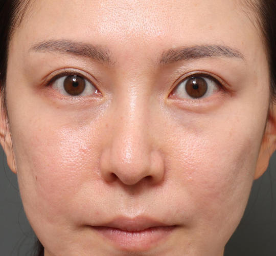 20代女性の目の下のクマ治療 Before 症例写真