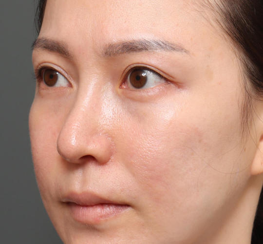 20代女性の下まぶたのたるみ取り Before 症例写真