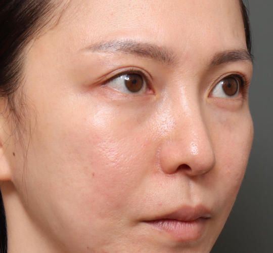 20代女性の下まぶたのたるみ取り Before 症例写真