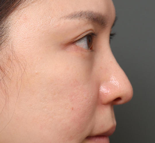 20代女性の下まぶたのたるみ取り Before 症例写真