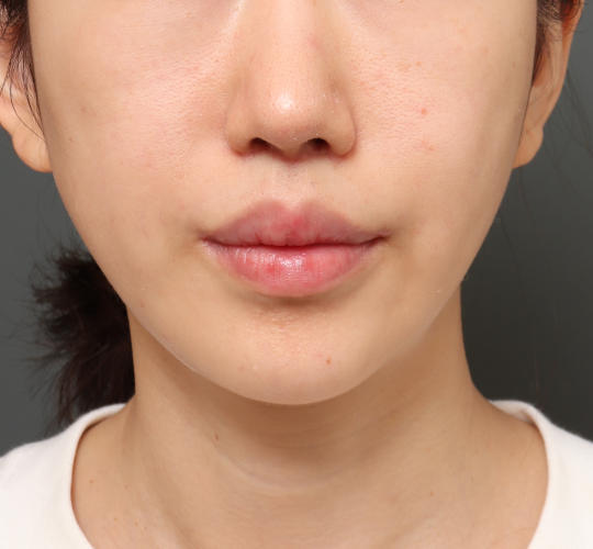 20代女性の唇・口元の整形 After 症例写真