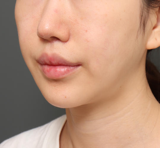 20代女性の人中短縮（リップリフト） After 症例写真