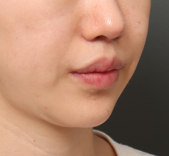 20代女性の人中短縮（リップリフト） After 症例写真