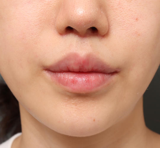 20代女性の人中短縮（リップリフト） After 症例写真