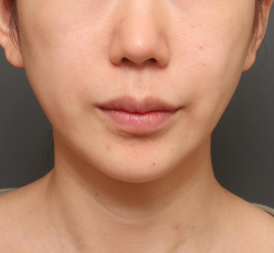 20代女性の唇・口元の整形 Before 症例写真