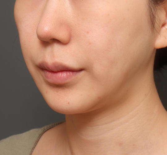 20代女性の人中短縮（リップリフト） Before 症例写真