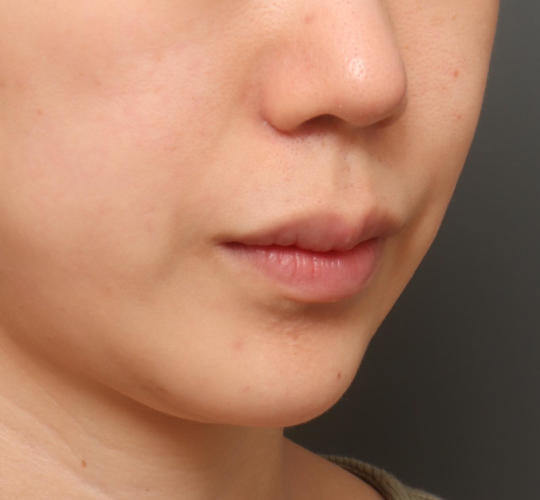 20代女性の人中短縮（リップリフト） Before 症例写真