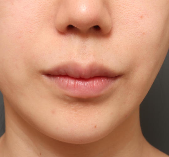 20代女性の人中短縮（リップリフト） Before 症例写真