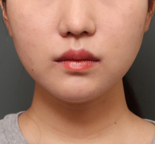 20代女性の口角挙上（スマイルリップ） After 症例写真