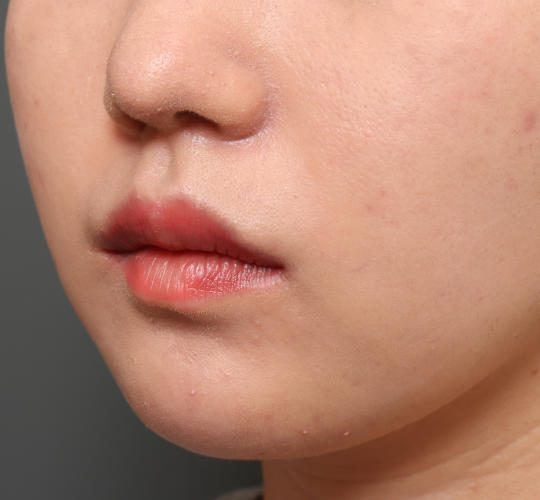 20代女性の唇・口元の整形 After 症例写真