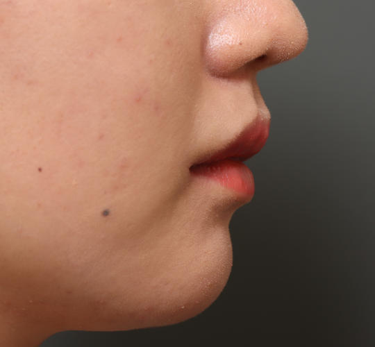 20代女性の口角挙上（スマイルリップ） After 症例写真