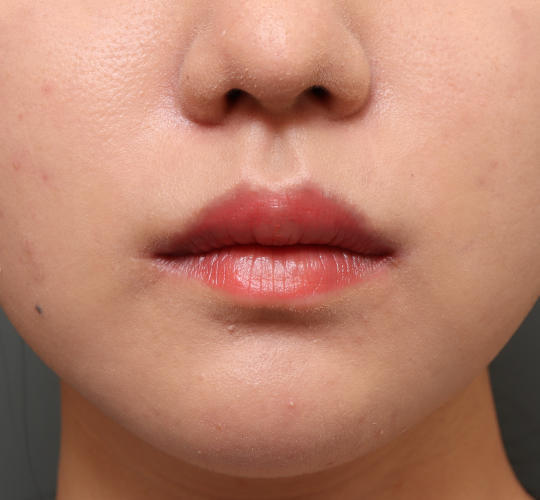 20代女性の口角挙上（スマイルリップ） After 症例写真
