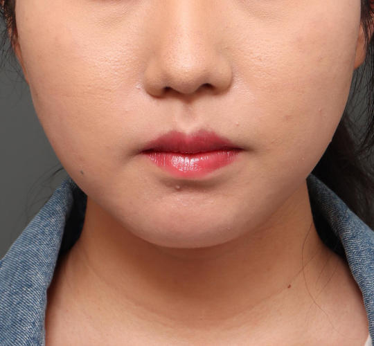 20代女性の口角挙上（スマイルリップ） Before 症例写真