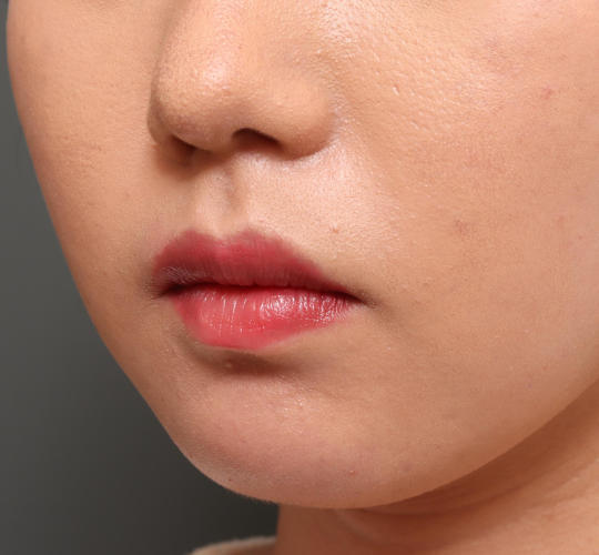 20代女性の唇・口元の整形 Before 症例写真