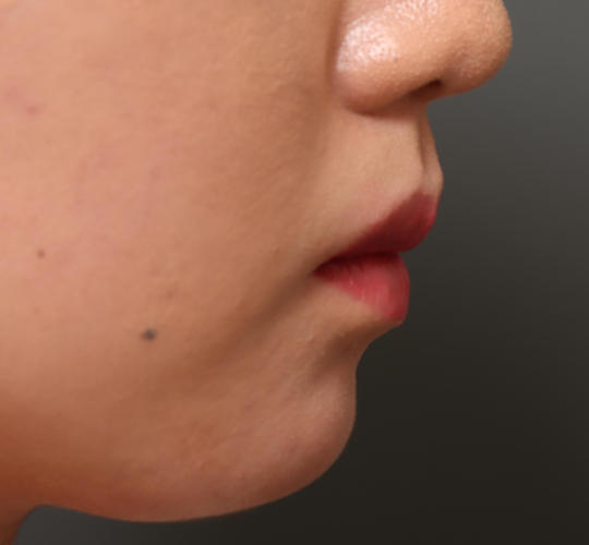 20代女性の口角挙上（スマイルリップ） Before 症例写真