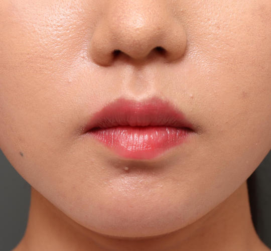 20代女性の口角挙上（スマイルリップ） Before 症例写真