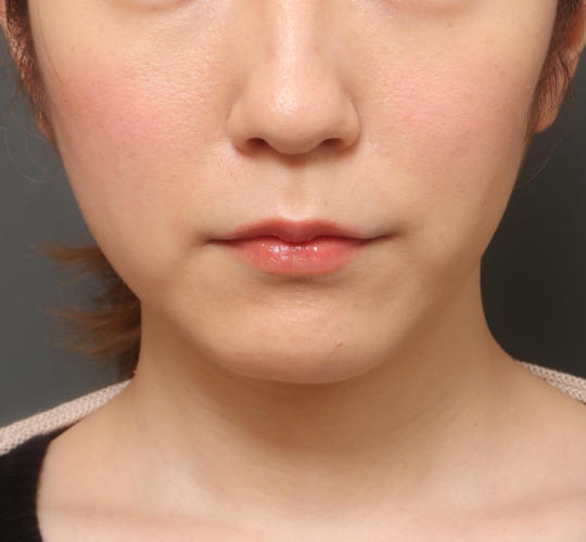 20代女性の人中短縮（リップリフト） Before 症例写真