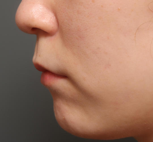 20代女性の人中短縮（リップリフト） Before 症例写真