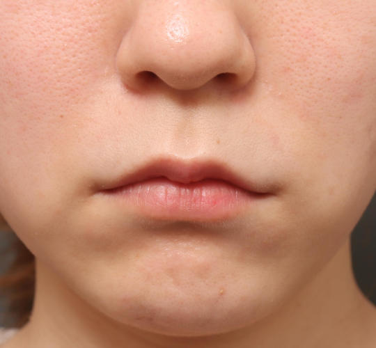 20代女性の唇・口元の整形 Before 症例写真