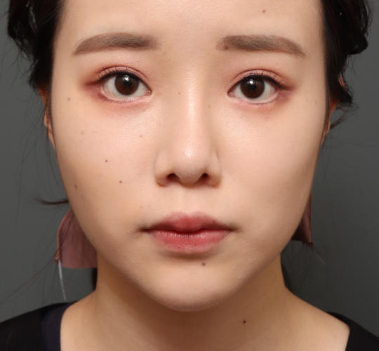 10代女性のバッカルファット除去 After 症例写真