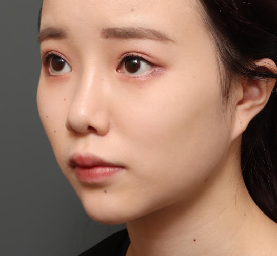 10代女性の肌再生高純度脂肪注入(脂肪移植) After 症例写真