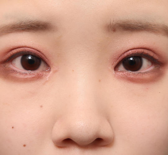 10代女性のバッカルファット除去 Before 症例写真