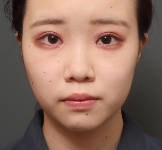 10代女性のバッカルファット除去 Before 症例写真