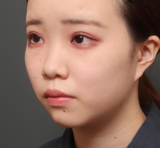 10代女性の肌再生高純度脂肪注入(脂肪移植) Before 症例写真