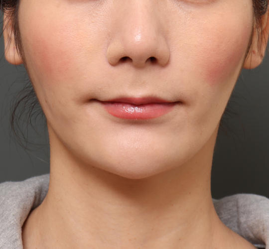 20代女性の顔の脂肪吸引  After 症例写真