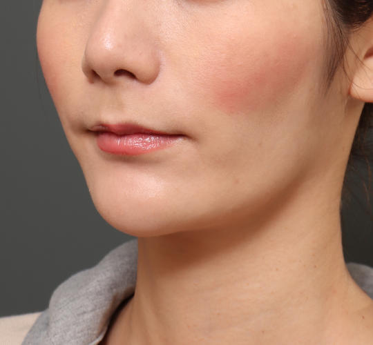 20代女性の顔の脂肪吸引  After 症例写真