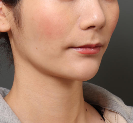20代女性の顔の脂肪吸引  After 症例写真