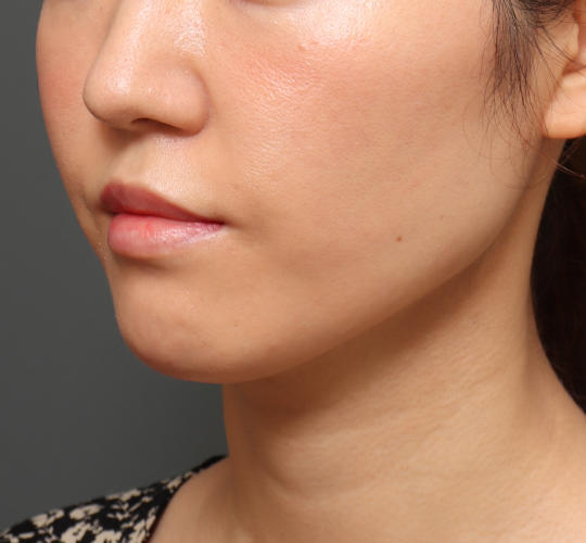 30代女性の顔の脂肪吸引  After 症例写真
