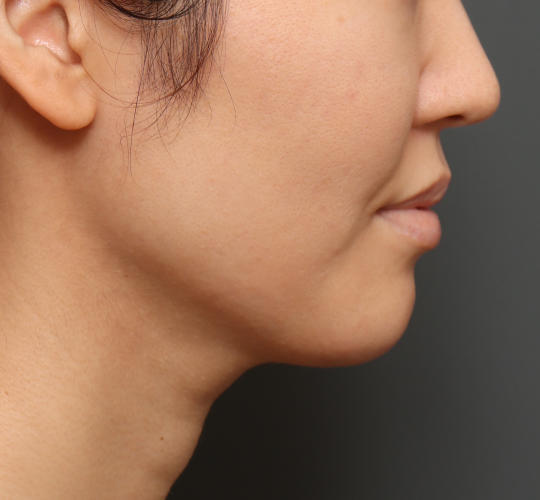 30代女性の顔の脂肪吸引  After 症例写真