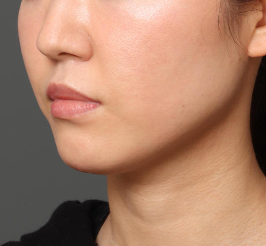 30代女性の顔の脂肪吸引  Before 症例写真