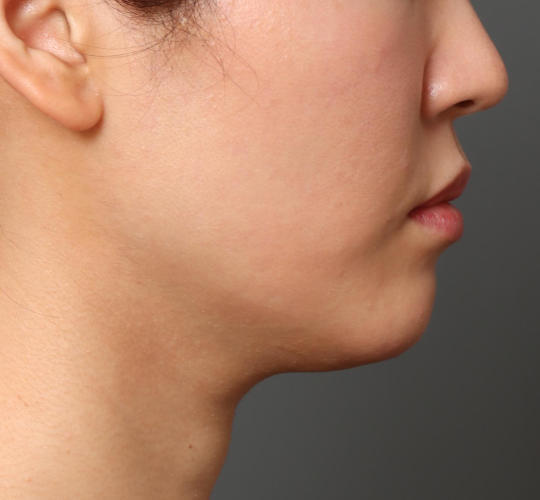 30代女性の顔の脂肪吸引  Before 症例写真