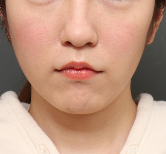 20代女性の人中短縮（リップリフト） After 症例写真