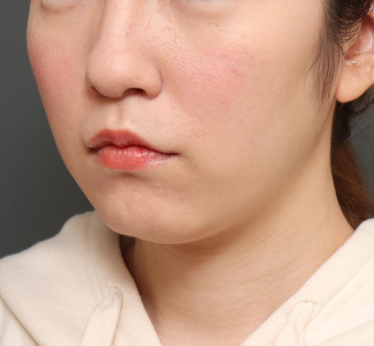 20代女性の人中短縮（リップリフト） After 症例写真